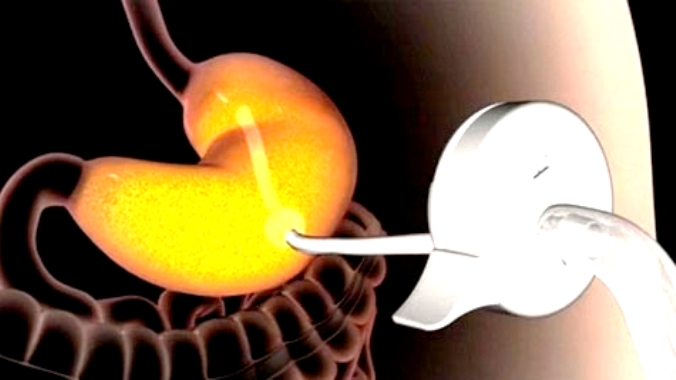 Помповый насос для желудка