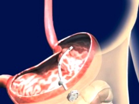 Помповый насос для желудка
